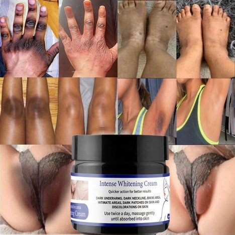 Crème Éclaircissante Intense pour Cuisses Internes Foncées, Zone du Maillot, Genoux, Articulations, Coudes et Parties Intimes